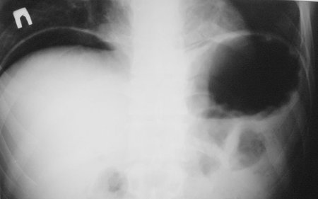 DSCN3223.jpg (24.54 КБ) 1351 просмотр Фрагмент обзорной рентгенограммы БП