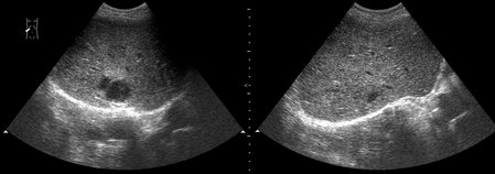 abscess-one_week_treatment.jpg (130.51 КБ) 1554 просмотра Маленький абсцесс печени до и на фоне 1 недели АБ-терапии