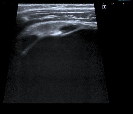 I20111223134834703.jpg (78.05 КБ) 875 просмотров Сканирование высокочастотным датчиком - резидуальная паренхима