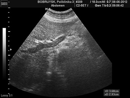 TROMB_21.JPG (128.53 КБ) 2391 просмотр Тромбоз правой и левой ветвей воротной вены