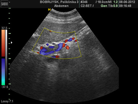 TROMB_28.JPG (122.08 КБ) 2391 просмотр Порто-портальные коллатерали