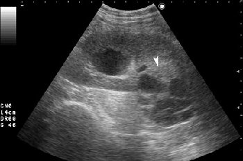 AAGP.jpg (24.49 КБ) 1642 просмотра Серошкальное УЗИ. В области нижнего полюса определяется образование сложной структуры (стрелка).