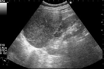 AAKV.jpg (29.41 КБ) 2797 просмотров Сонограмма правой почки.