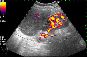 AAKU.jpg (38.51 КБ) 2796 просмотров Образование в режиме энергетического доплера.