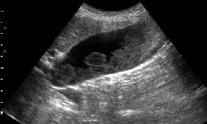 2.jpg (20.53 КБ) 1943 просмотра Сонограмма желчного пузыря при поступлении в стационар.