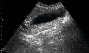 1.jpg (19.38 КБ) 2114 просмотров Повторная сонограмма через сутки.
