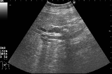AAEE.jpg (30.97 КБ) 2204 просмотра Продольный скан холедоха