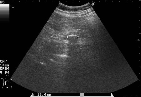 AAEC.jpg (27.61 КБ) 2015 просмотров Поперечный скан холедоха