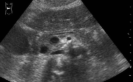 123313.jpg (27.69 КБ) 3524 просмотра Продольная сонограмма панкреас