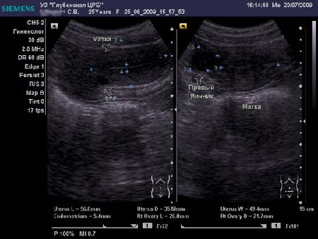20.07.09.jpg (39.16 КБ) 8900 просмотров Сонограмма при первом обращении