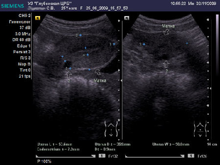 2.11.09.jpg (39.42 КБ) 8891 просмотр Сонограмма после курса противовоспалительной терапии